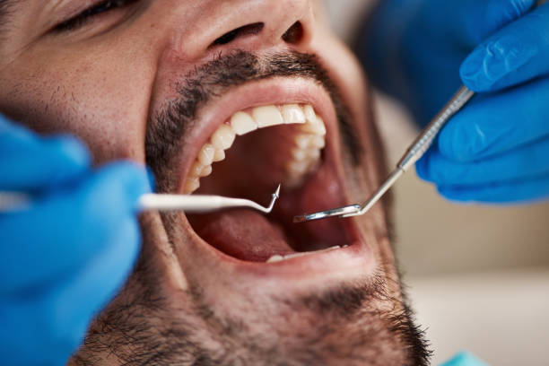 Best Broken or Cracked Tooth Emergency Dentist in Mpbell, CA